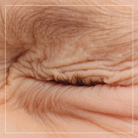 Blefaroespasmo - Distonias palpebrais com Toxina Botulínica