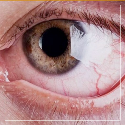 Glaucoma